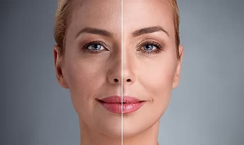 Fat Transfer To Face